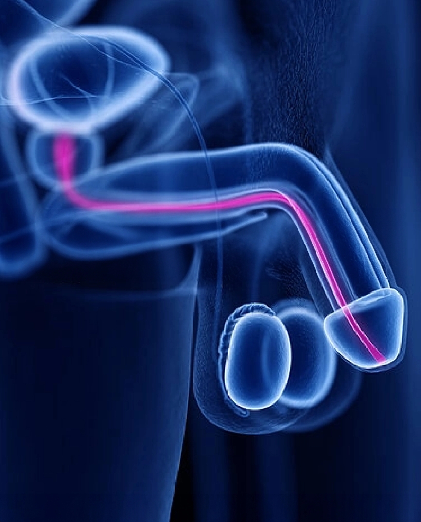 uretritis